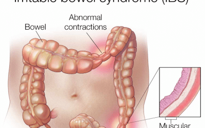 আইবিএস (IBS – Irritable Bowel Syndrome) – কারণ, লক্ষণ ও কমানোর উপায়