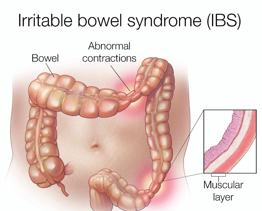 Diet for IBS (Irritable Bowel syndrome)