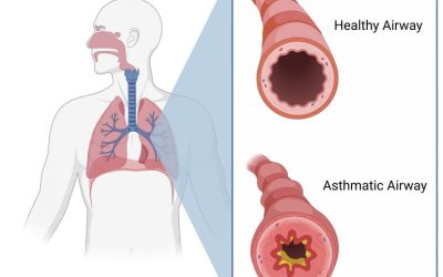 Asthma treatment