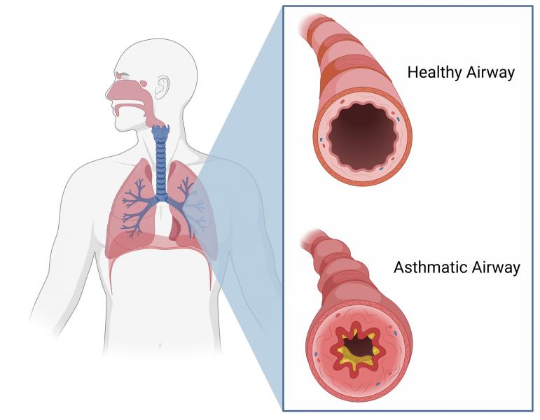 Asthma treatment