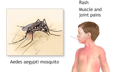 Dengue Fever Treatment