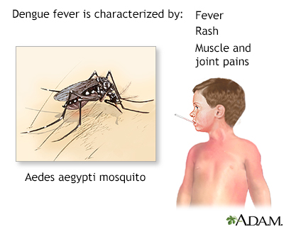 Dengue Fever Treatment