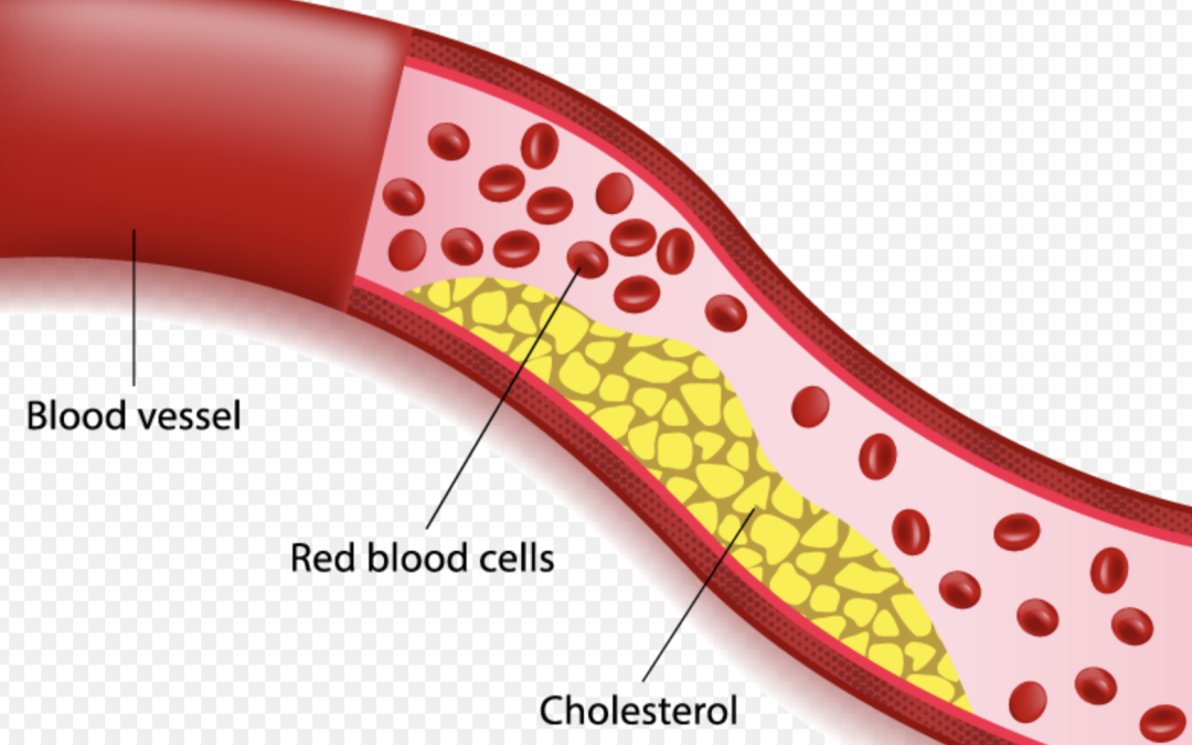 Dyslipidemia treatment - Dr. Debabrata Sarkar