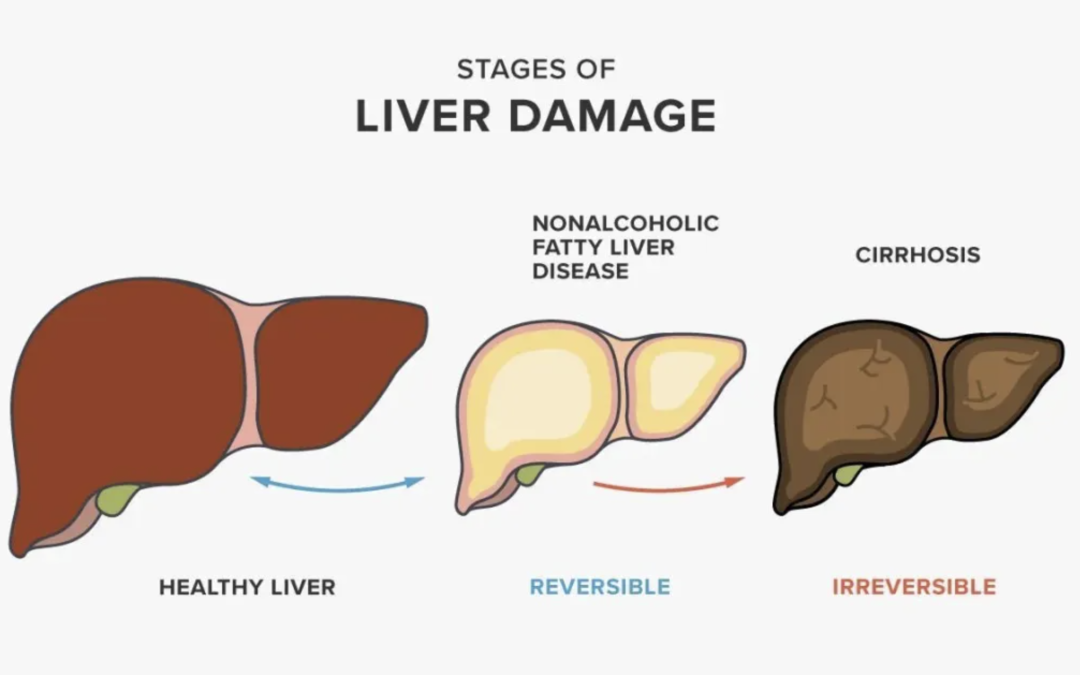 Fatty Liver treatment