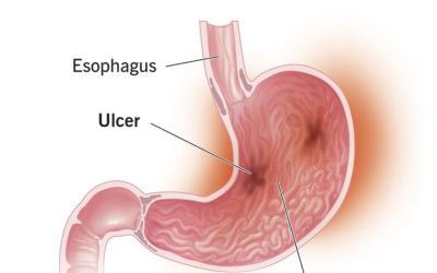 Gastritis treatment