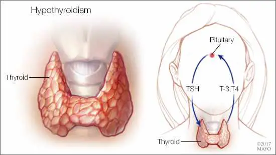 Diet in hypothyroidism