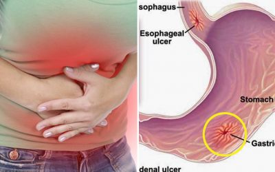 গ্যাস্ট্রাইটিস সারানোর সহজ উপায়